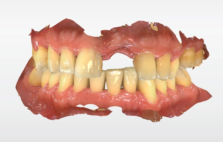 Abb. 3: Der Intraoralscan in Schlussbiss war Grundlage für das Digital Smile Design mit der CEREC-Software.