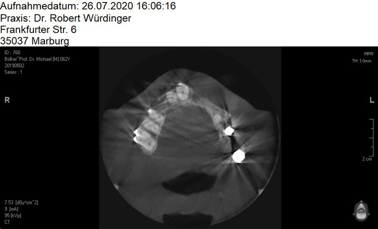 Abb. 3: 3D-Darstellung des Knochendefekts vor Augmentation.