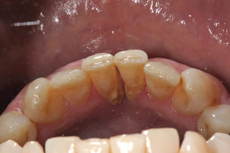 Abb. 1–4: Ausgangssituation: parodontaler Defekt mesial an 31/41.
