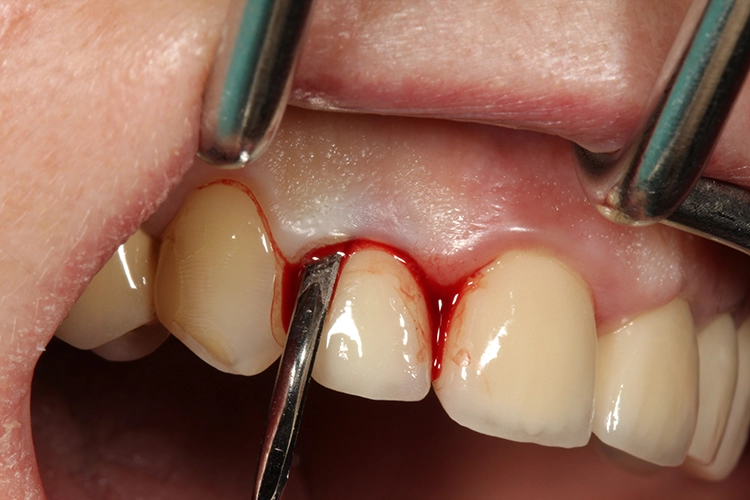 Abb. 3: Schonendes Ablösen der marginalen Gingiva und der desmodontalen Fasern mittels Periotomen.