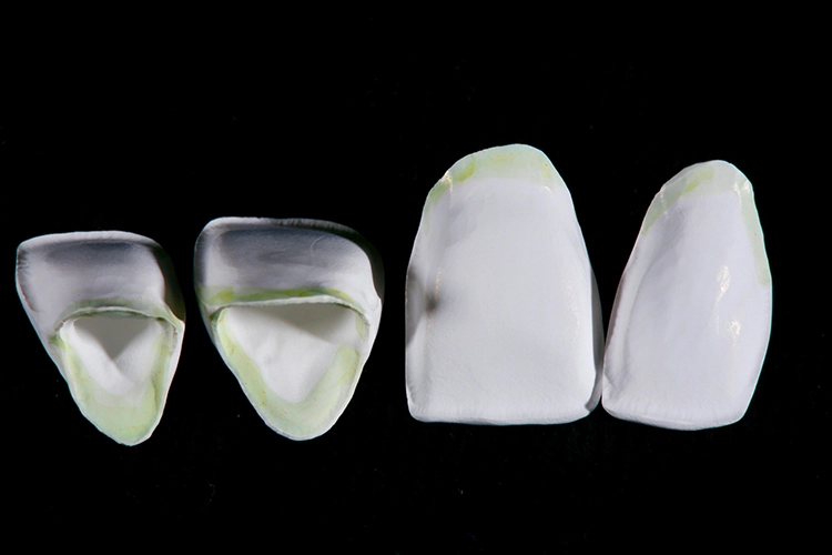 Abb. 3: Anatomisch leicht reduzierte Kronen aus IPS e.max ZirCAD Prime – mit Infiltrationsliquids leicht am zervikalen Rand eingefärbt.