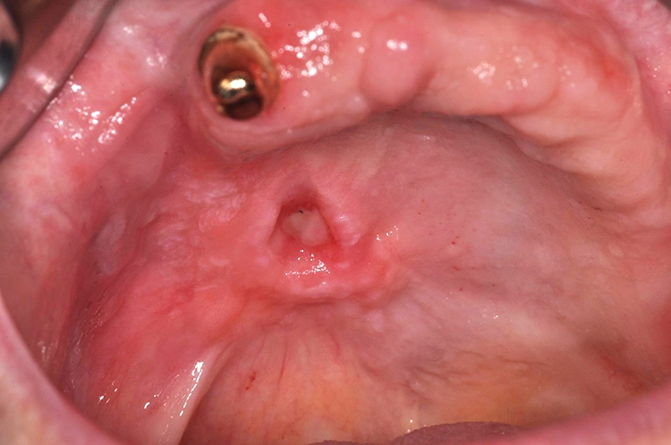 Carcinoma in situ, SIN 3: Es hat die Basalmembran noch nicht durchbrochen und ist daher auf das Ursprungsgewebe begrenzt. Unbehandelt besteht zu 90% das Risiko zur Entwicklung eines invasiven Karzinoms [1,4].