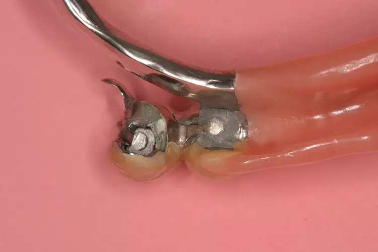 Abb. 3: Intraoral verklebte Matrize in die vorhandene ausgeschliffene und
laborseitig in die Arbeit verklebte Geschiebekrone (Basalansicht).