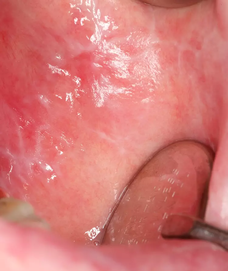 Abb. 3: Oraler Lichen planus der Wange mit Wickhamscher Streifung.