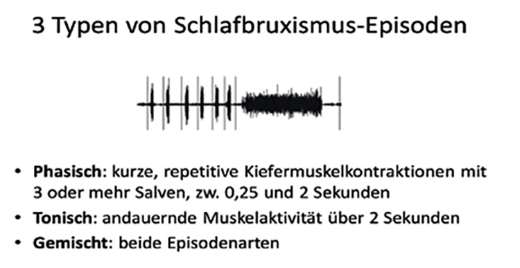 Abb. 3: Schlafbruxismusepisoden sind entweder phasisch, tonisch oder gemischt.