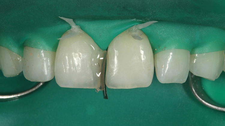 Abb. 3: Mit Hilfe eines lichthärtenden Provisorium-Materials mesial an Zahn 21 fixierte Teilmatrize.