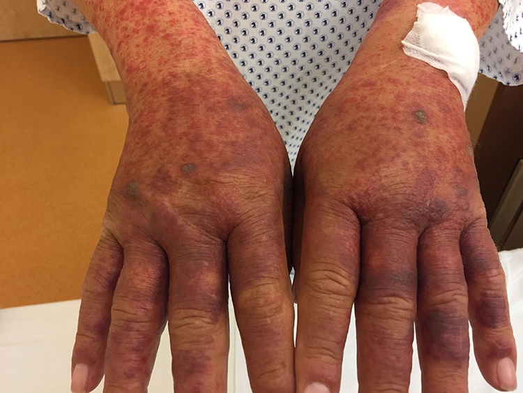 Abb. 3: Makulöse/makulopapulöse Läsionen als Symptom einer Amoxicillinallergie vom Spättyp.
