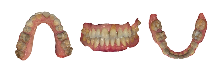 Abb. 3: 3D-Intraoralscans (TRIOS 4) mit Farbinformation eines Patienten für die Versorgung von Inlays und Teilkronen im Ober- und Unterkiefer.