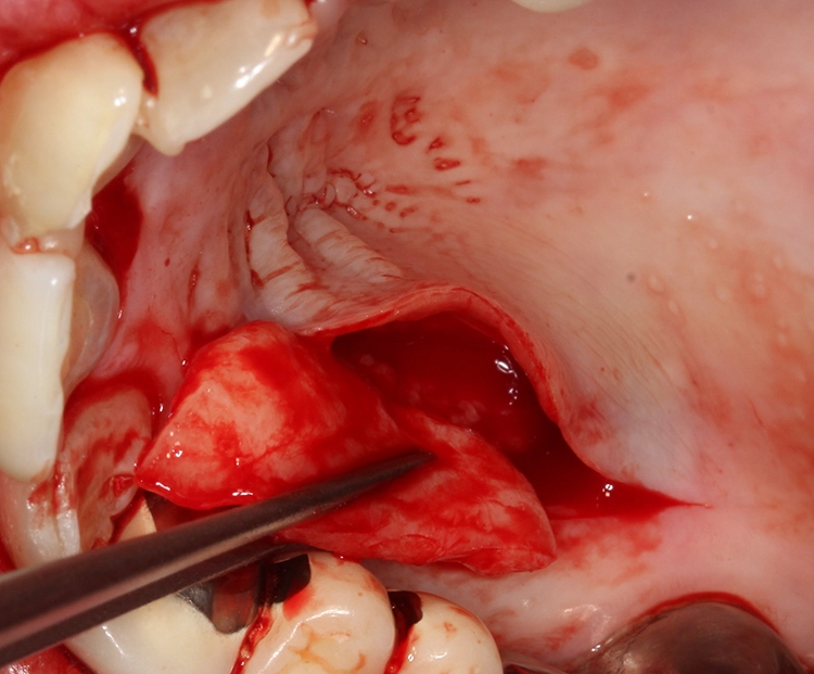 Abb. 3: Entnahme des Transplantates am Gaumen mittels Single-Incision-Technik.