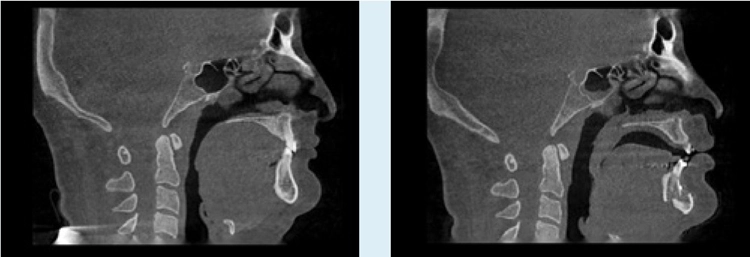 Abb. 3: Darstellung des Posterior Airway Space (PAS) im sagittalen Schnittbild des DVT.
a: Deutliche Einengung des PAS in der oberen und mittleren Etage prä op.
b: Erweiterung des PAS in beiden Etagen nach MMCA mit Rotation gegen den Uhrzeigersinn und deutliche Vergrößerung des Zungenfunktionsraumes 6 Wochen post op.