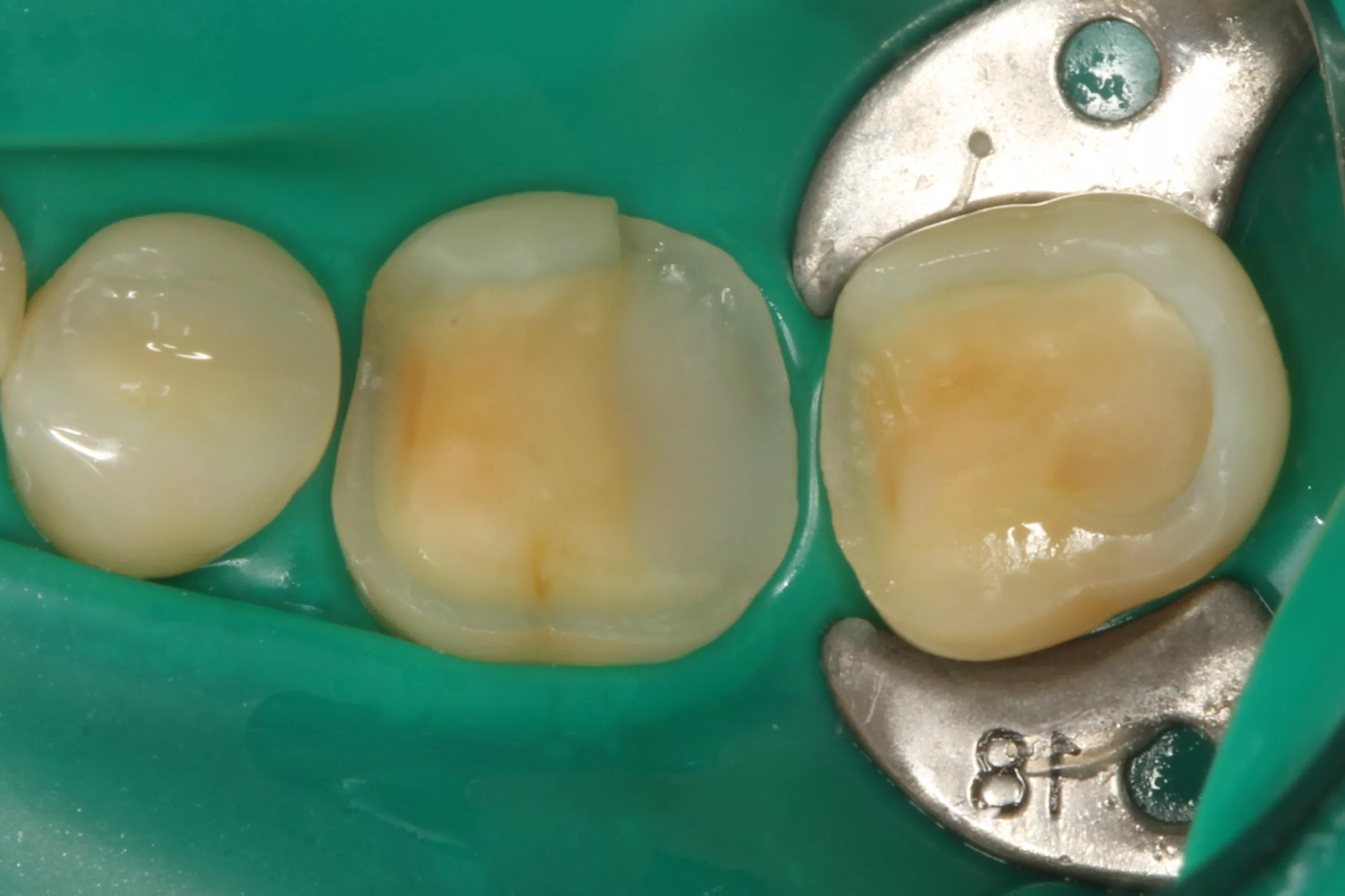 Abb. 3: Einwirkung des Visalys Tooth Primers auf die Präparationsflächen der beiden Zähne 46 und 47.
