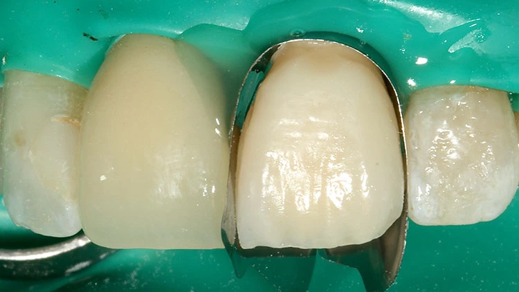 Abb. 3: Mit einem lichthärtenden, gummielastischen Provisoriummaterial fixierte Matrize.