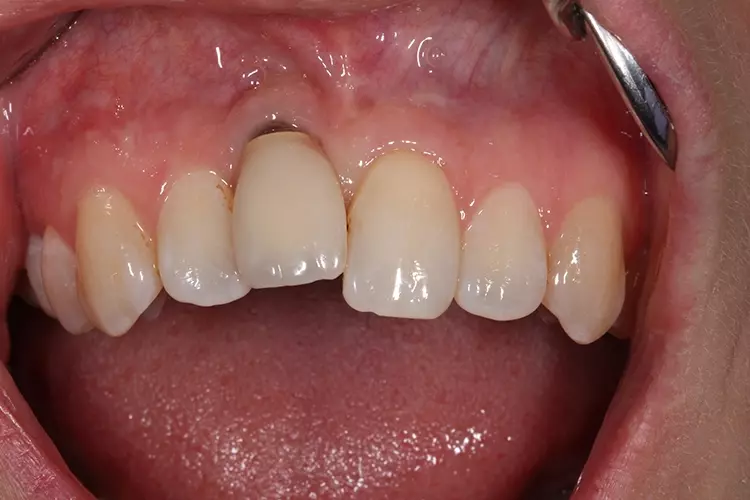 Abb. 3a: 11 Implantation 1996 im Alter von 17,5
Jahren.