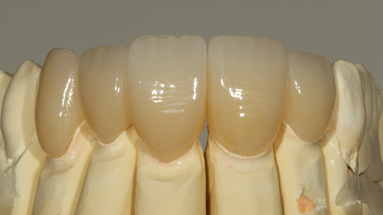 Abb. 10: Labial verblendete Volllzirkonteilkronen und Veneers mit Schneidekanteneinfassung für die Zähne 12 bis 23 auf dem Labormodell.