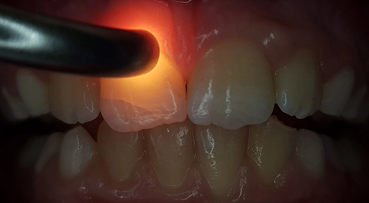 Abb. 3: Bei genauerer Untersuchung mit Kaltlicht/FOTI wird ein Riss des Zahnschmelzes (Schmelzinfraktion) an Zahn 11 sichtbar. Daraufhin wurde der Patient spezifisch zum dentalen Trauma mithilfe eines Traumadokumentationsbogens systematisch befragt und die Angaben wurden erfasst.
