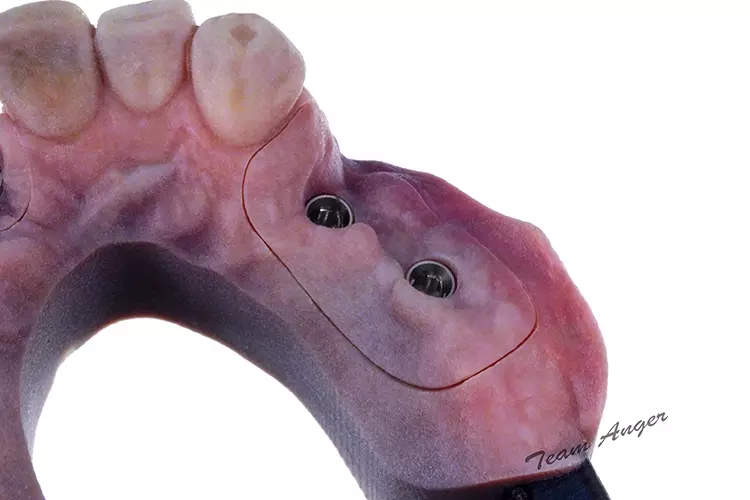 Abb. 3b: Modelle mit Modellimplantaten, abnehmbaren Zahnfleischmasken und beschliffenen Zahnstümpfen aus dem J5-Drucker unter Farbwiedergabe aus einer
PLY-Datei. Das Gelenk wird direkt mit gedruckt. Design: exocad DentalCAD Elefsina.