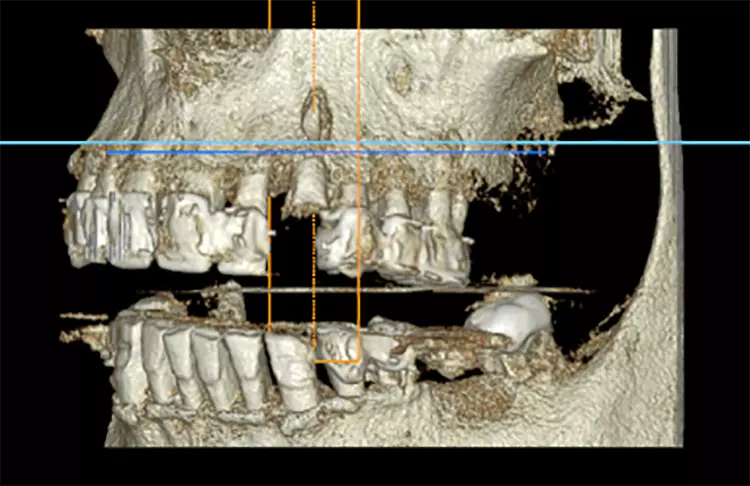 Abb. 3c: 3D-Darstellung des Kiefers.