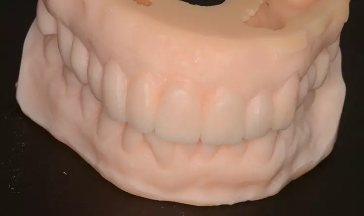 Abb. 3c: Wax-up.