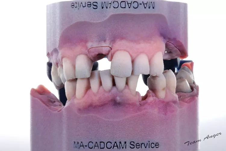 Abb. 3c: Modelle mit Modellimplantaten, abnehmbaren Zahnfleischmasken und beschliffenen Zahnstümpfen aus dem J5-Drucker unter Farbwiedergabe aus einer
PLY-Datei. Das Gelenk wird direkt mit gedruckt. Design: exocad DentalCAD Elefsina.