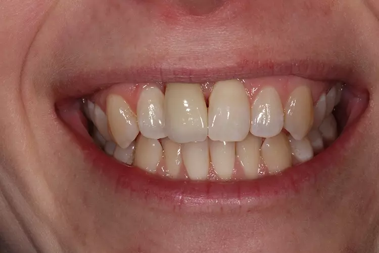 Abb. 3d: Klinischer Zustand mit keramischen Abutment und neuer Krone.