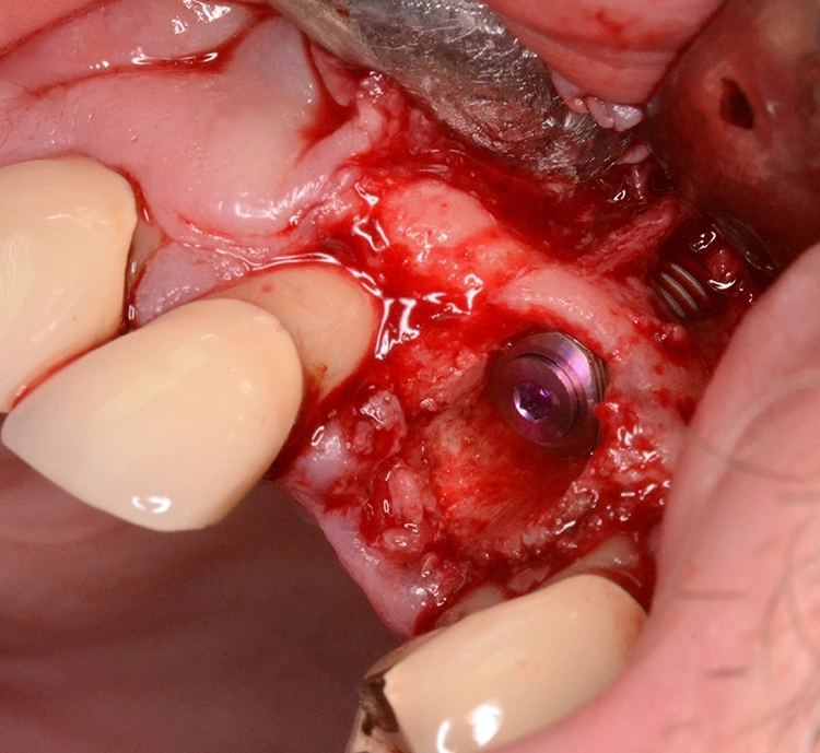 Abb. 3d: Implantation.