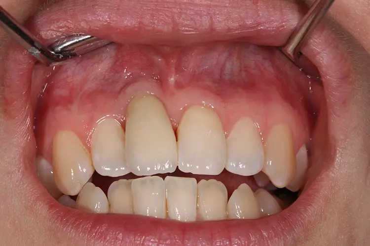 Abb. 3e: Klinischer Zustand mit keramischen Abutment und neuer Krone.