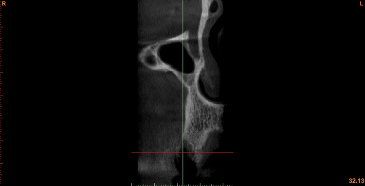Abb. 5: Am DVT (Simplant Pro) diagnostizierter knöcherner Defekt im vestibulären Bereich regio 15.