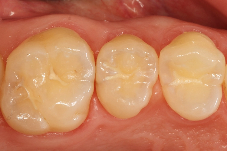 Abb. 13: Kariesverdacht distal an Zahn 25.