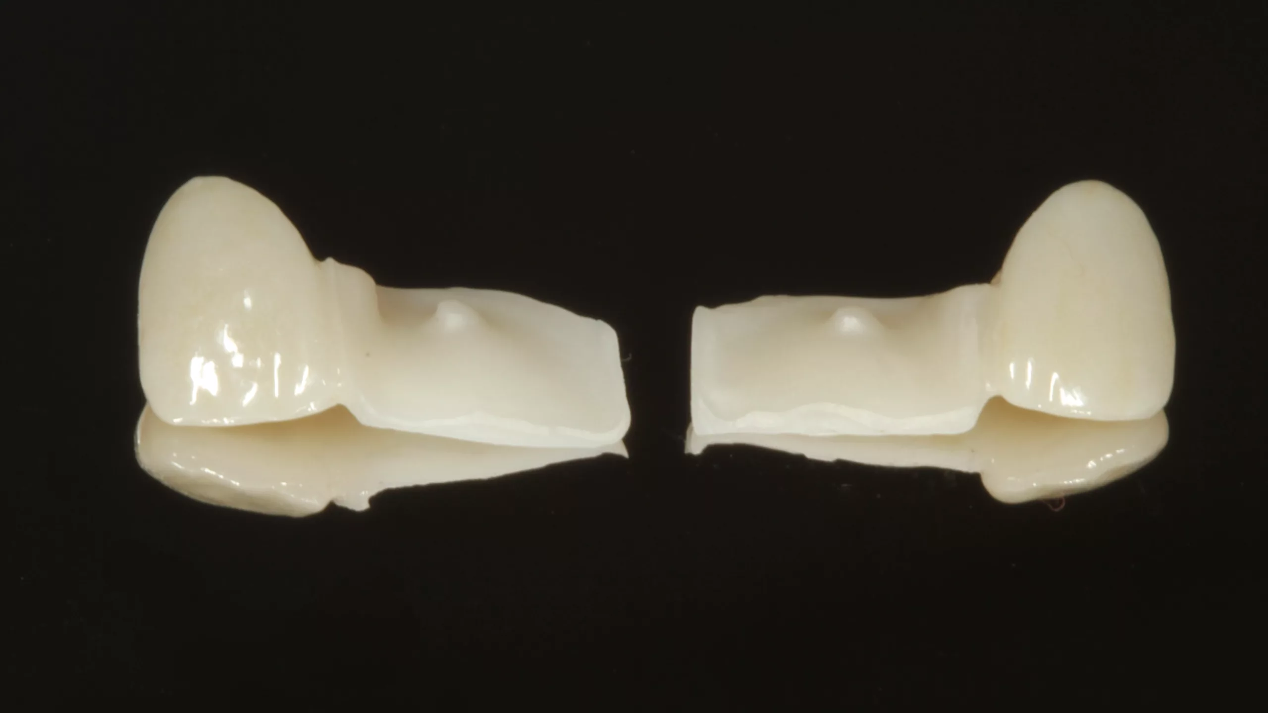 Abb. 38: Einflügelige Klebebrücken zum Ersatz der Zähne 12 und 22. Die Klebeflügel werden jeweils an den mittleren Schneidezähnen befestigt.