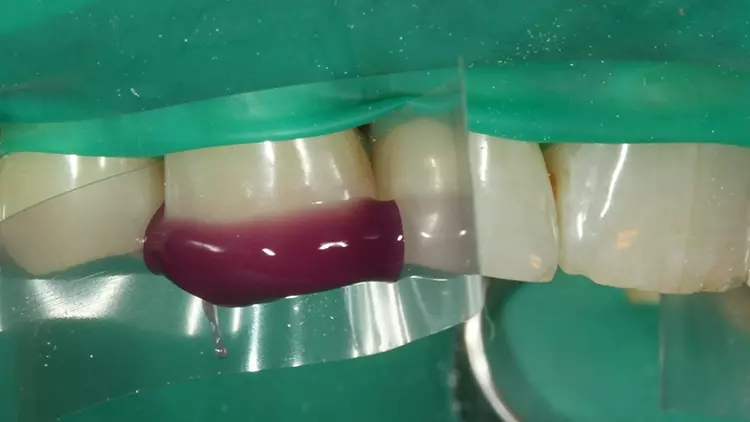 Abb. 40: Die Phosphorsäurekonditionierung mit dem Optibond Gel Etchant.