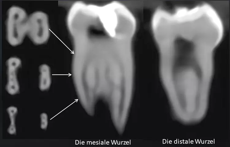 Abb. 41: DVT-Aufnahme eines extrahierten 2. Milchmolaren mit 6 Wurzelkanälen.
