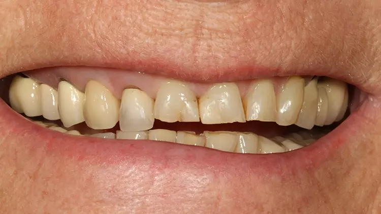 Abb. 41: Lippenbild unmittelbar vor der Kronen- und Veneerpräparation.