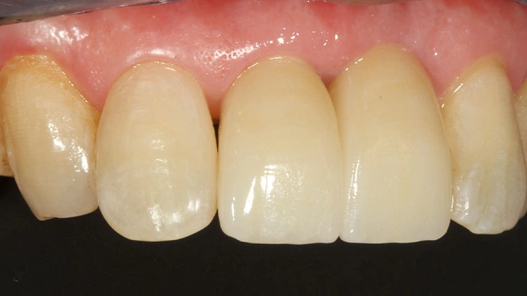 Abb. 20: Die Situation nach einem Jahr: Ein zervikaler Komposit-Überschuss ist entfernt, die gingivalen Verhältnisse sind gesund und das schwarze Dreieck ist zur Zufriedenheit des Patienten deutlich reduziert.