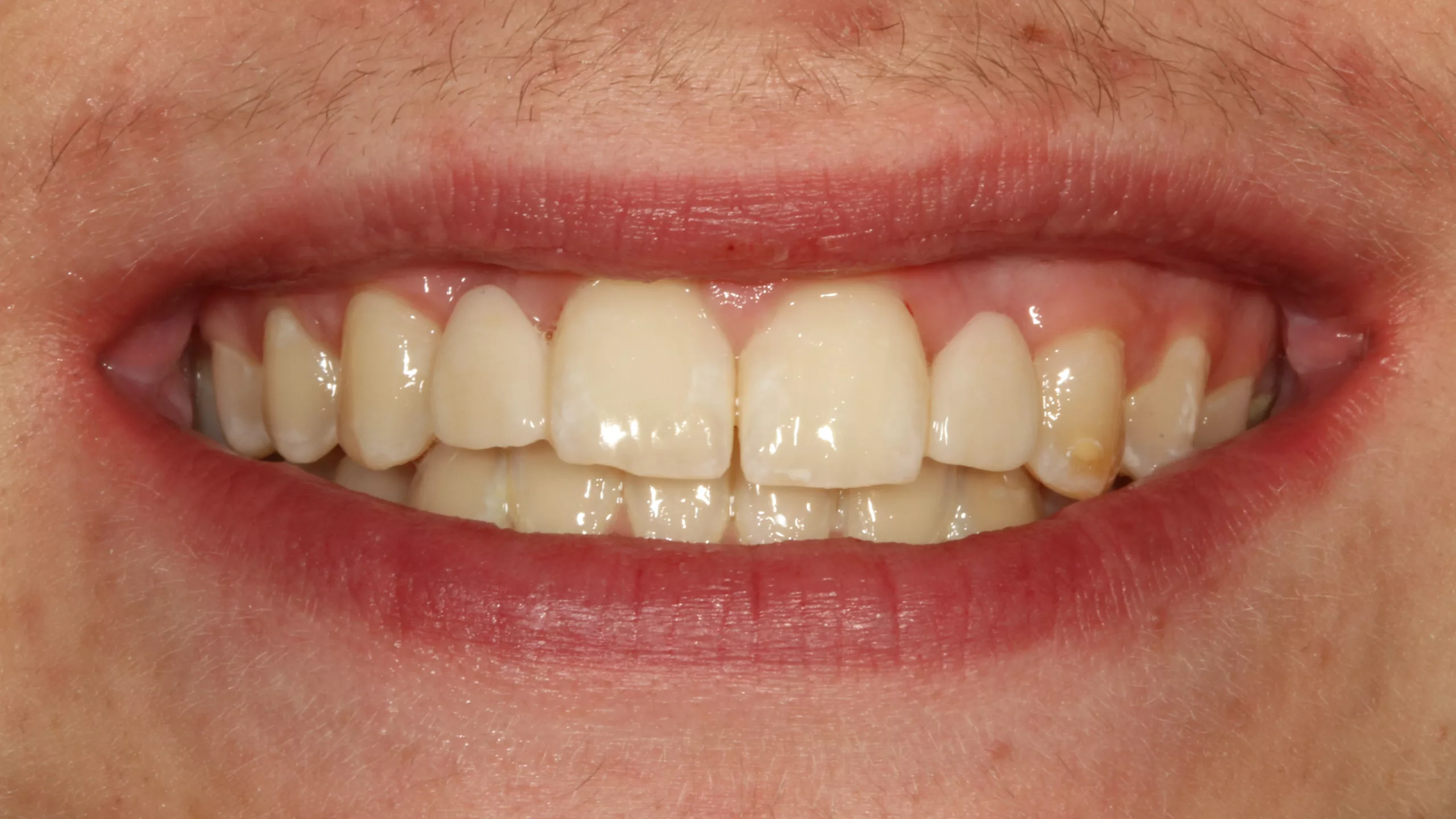 Abb. 53: Der jugendliche Patient freut sich über seine neuen Zähne.