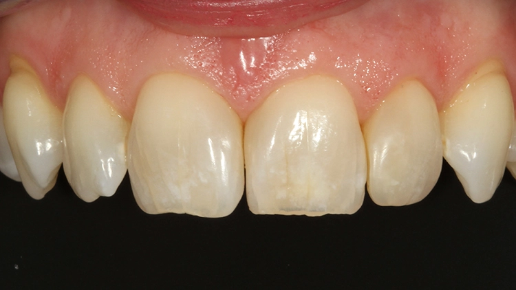 Abb. 24: En-face-Ansicht bei der 6-Monats-Nachuntersuchung: Alle Restaurationen (11, 21 und 22) fügen sich ästhetisch perfekt in die vorhandene Zahnhartsubstanz ein; die Gingiva ist reizlos, die schwarzen Dreiecke bleiben verschwunden.