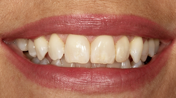 Abb. 25: Lippen-Abschlussbild der hochzufriedenen Patientin.