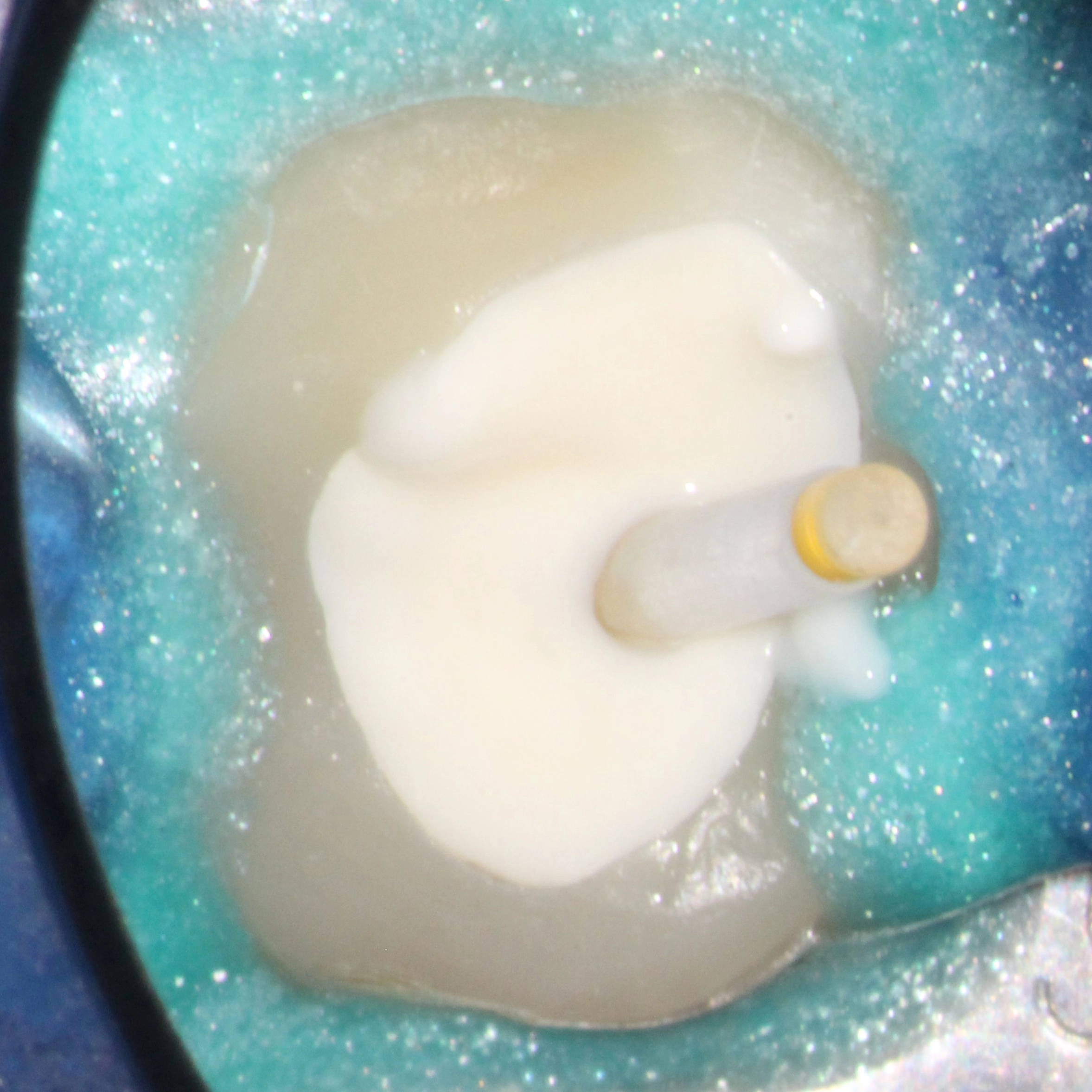 Abb. 59: Fertig aufgefüllte Kavität.