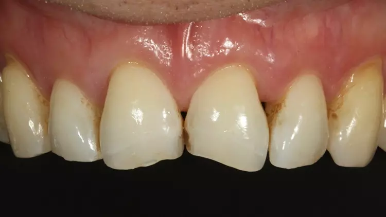 Abb. 49: Detailaufnahme unmittelbar vor der Präparation der Schneidezähne
zur Aufnahme glaskeramischer Veneers.