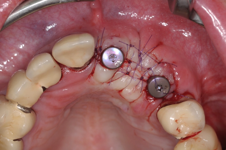 Abb. 14: Operative Freilegung mit kombinierter apikalen Lappenverschiebung, Rolllappen regio 21, 23 und Interposition eines freien Tubertransplantats in regio 22.