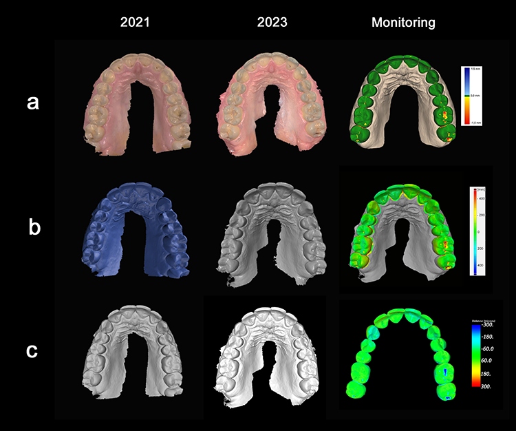 Abb. 4: Überlagerung von Intraoralscans des Oberkiefers eines 37-jährigen Patienten aus dem Jahr 2021 und 2023 zum Monitoring von initialen, nicht kariesbedingten
Zahnhartsubstanzverlusten in der systemimmanenten Intraoralscanner-Software des Trios 5 (3Shape, a), der externen 3D-Analysesoftware Gom Inspect (b) und der
externen Analysesoftware für Zahnverschleiß der University of Leeds (c).
