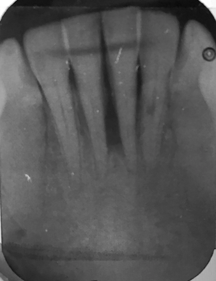 Abb. 1–4: Ausgangssituation: parodontaler Defekt mesial an 31/41.