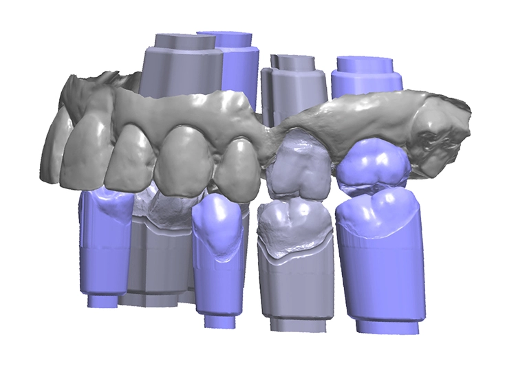 Abb. 4–6: Digitale Erstellung der Meistermodelle mit Steckstümpfen mithilfe der 3Shape Modelbuilder-Software (Dental System 2020 V20.1).