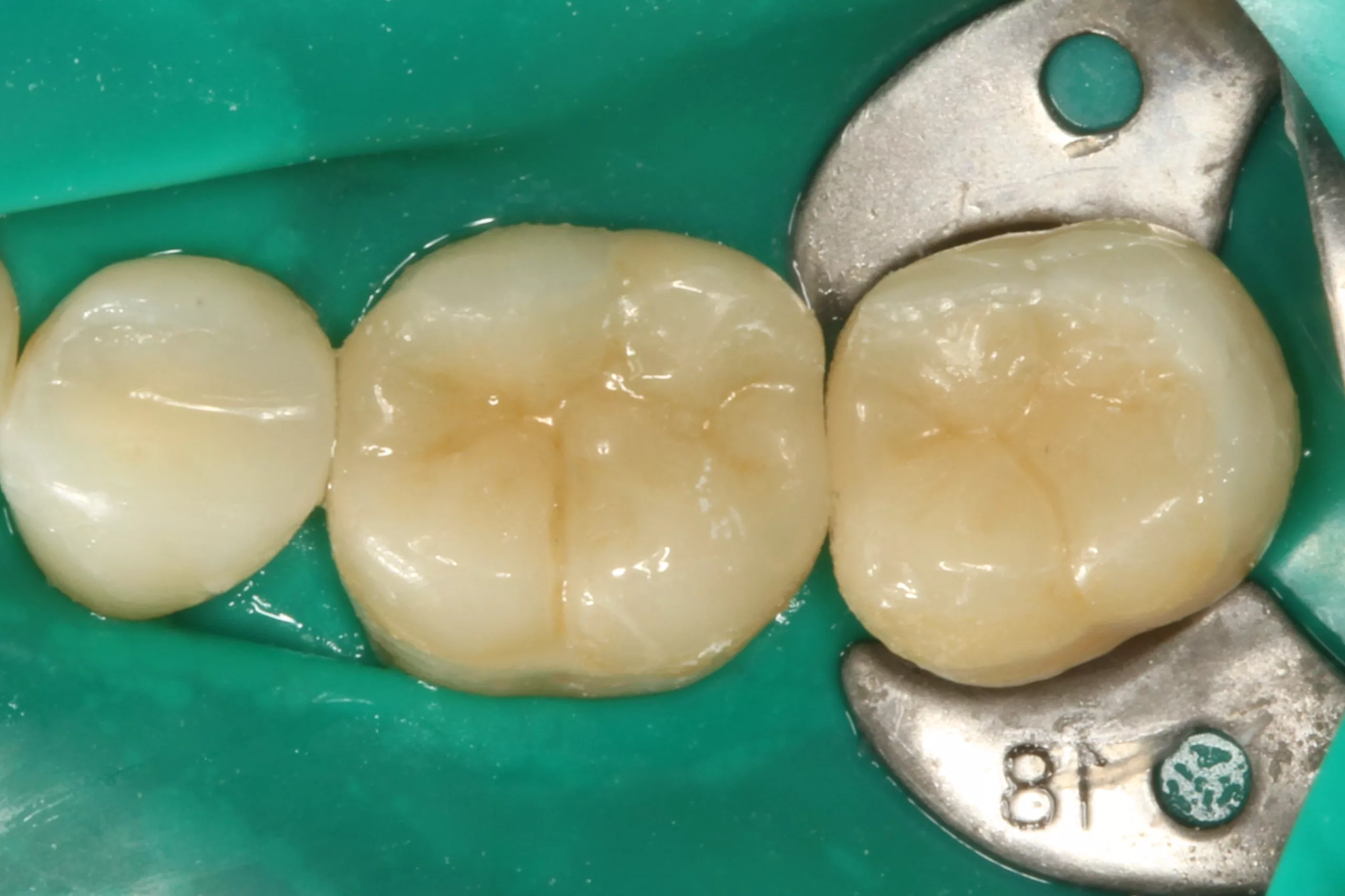 Abb. 4: Befestigung der beiden Teilkronen erfolgte gleichzeitig mit Visalys CemCore in der Farbe Universal (A2/A3).