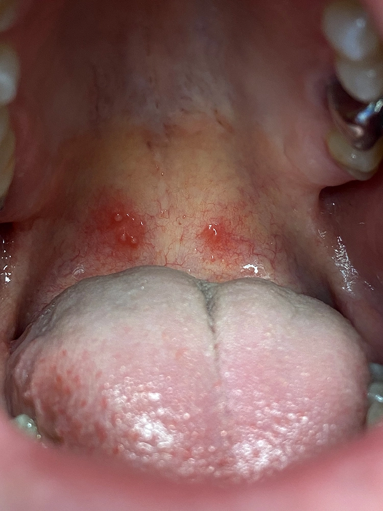 Abb. 4: Gruppierte Herpes-simplex-Effloreszenzen im Bereich des weichen Gaumens.