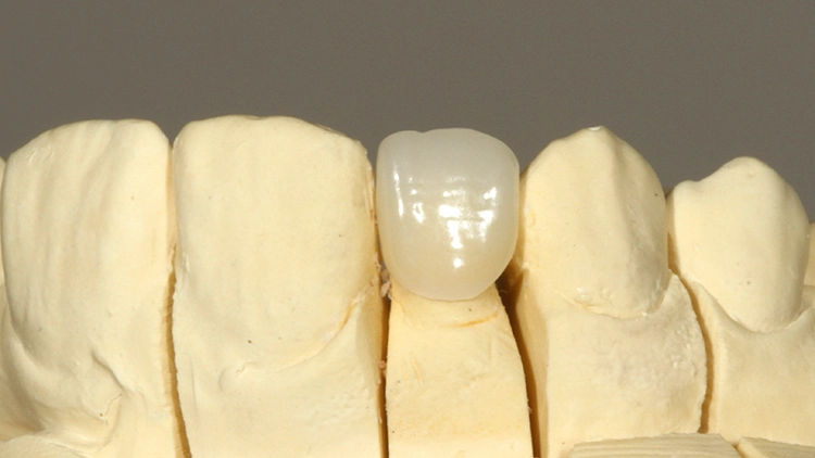 Abb. 4: IPS e.max Press-Krone auf dem Labormodell in Ansicht von labial.