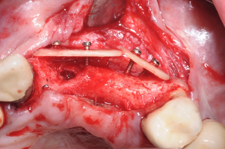Abb. 4: Anbringung der allogenen Kortikalisplatten zur Herstellung der äußeren Kieferkammkontur.