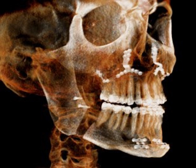 Abb. 4: DVT unmittelbar post op mit Darstellung der Verlagerungen und der Osteosynthese beim bimaxillären Rotationsadvancement mit Kinnrandverschiebung.