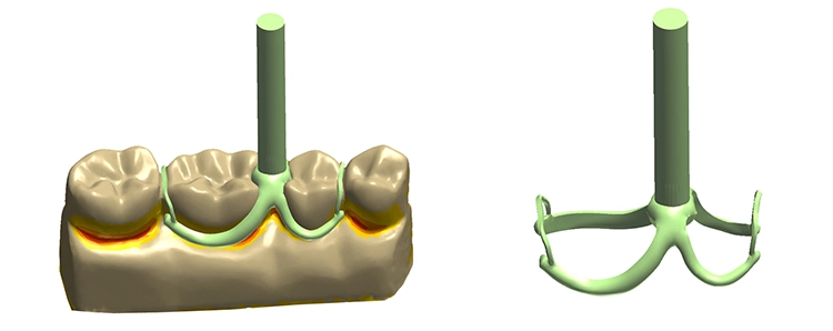 Abb. 4: Fertige CAD-Konstruktion der Studien-Klammer (Verbindung an den Klammerspitzen dient der Formstabilität beim 3D-Druckvorgang und wird final abgetrennt).