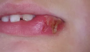 Typisches Verletzungsmuster einer Bissverletzung nach Lokalanästhesie im Unterkiefer.