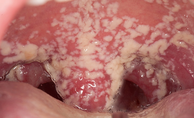 Abb. 4: Pseudomembranöse oropharyngeale Candidiasis bei einem 19-jährigen HIV-seropositiven männlichen Patienten.